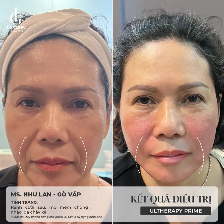Hình ảnh ba Ultherapy Prime 03
