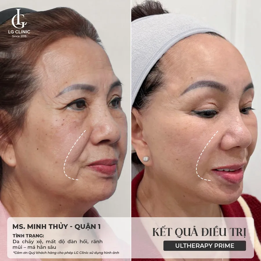 Hình ảnh ba Ultherapy Prime 04