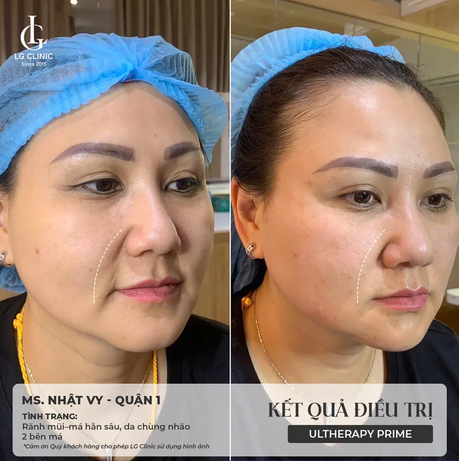 Hình ảnh ba Ultherapy Prime 05