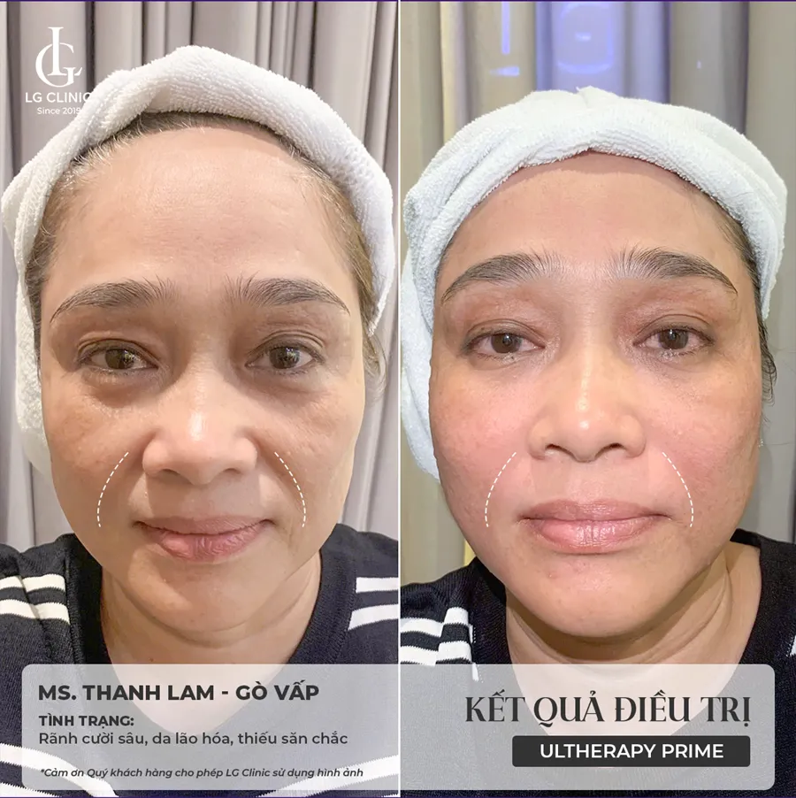 Hình ảnh ba Ultherapy Prime 06
