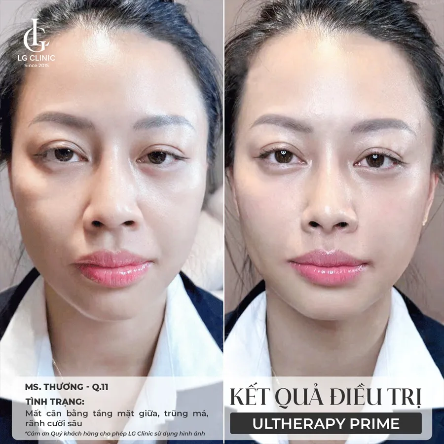 Hình ảnh ba Ultherapy Prime 07