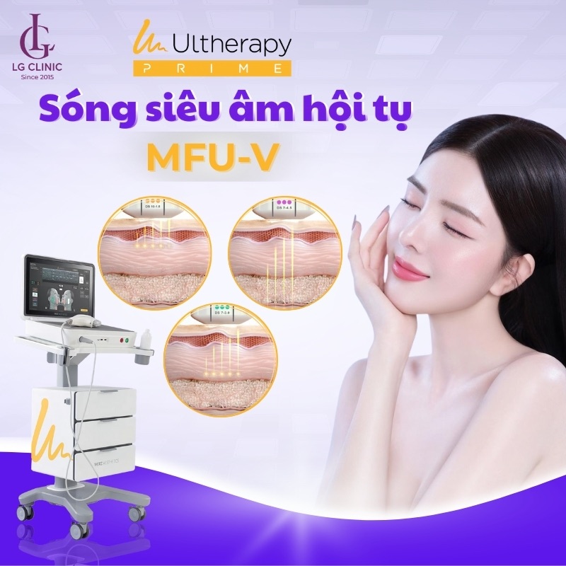 sóng mfu-v