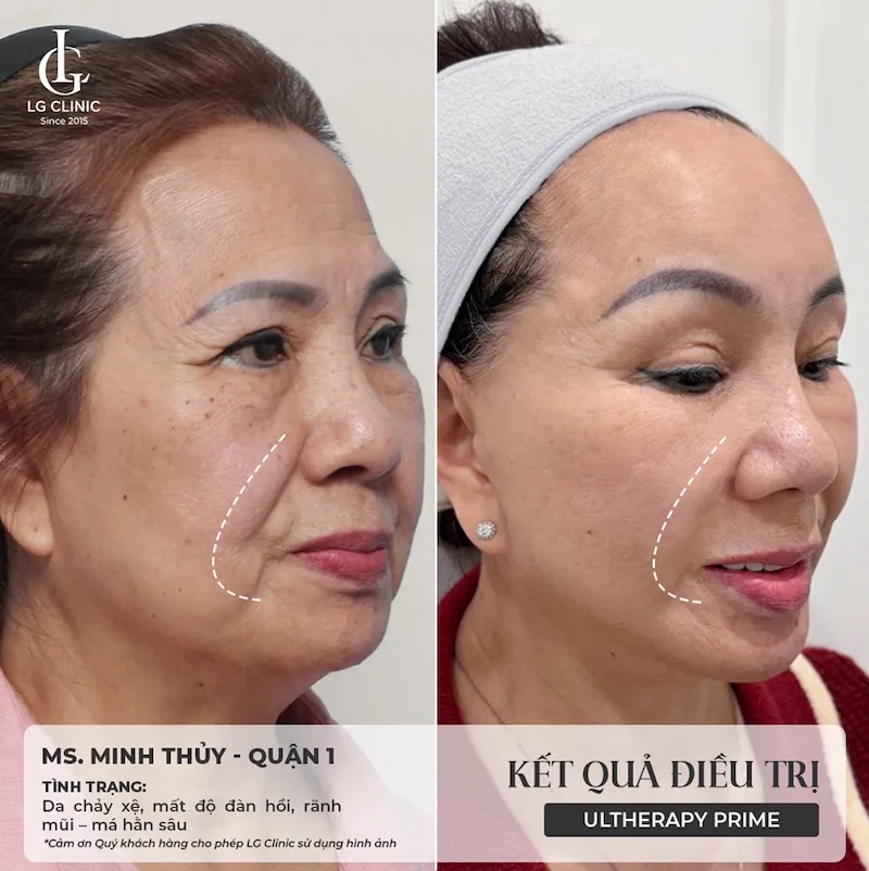 người có làn da chảy xệ nên làm ultherapy