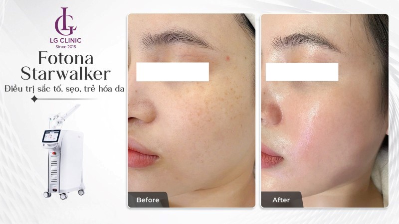 laser fotona trị sắc tố