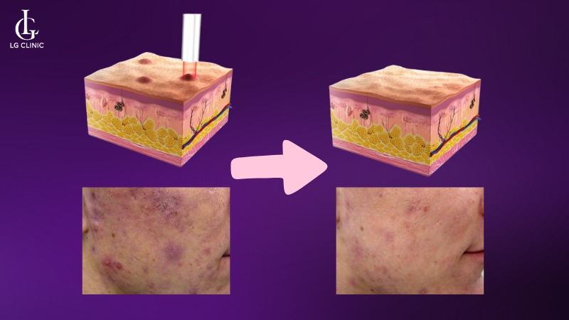 laser fotona trị mụn