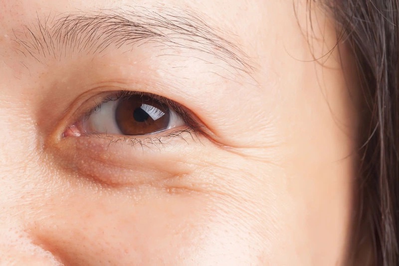 nâng cơ đuôi mắt khi có dấu hiệu già hoá