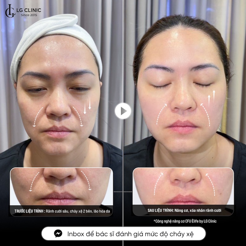 Người có da kém săn chắc nên sử dụng nâng cơ mặt không phẫu thuật