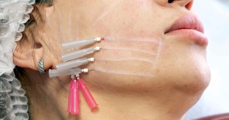căng chỉ collagen