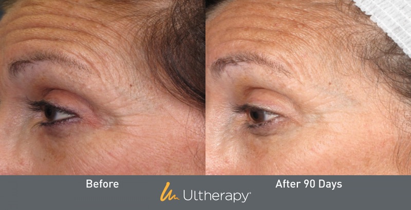 kết quả Ultherapy vùng mắt