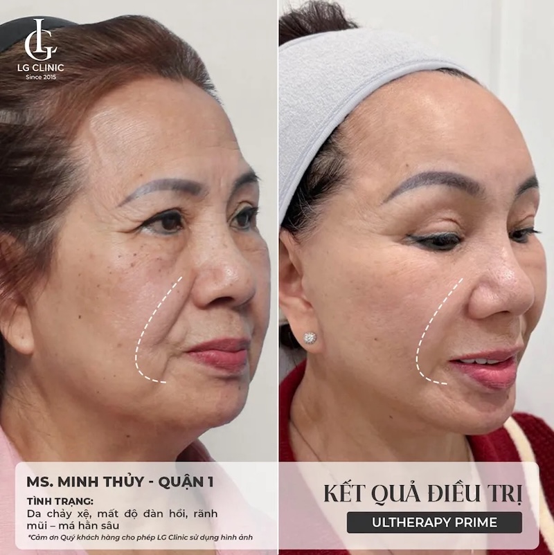 kết quả nâng cơ ultherapy prime