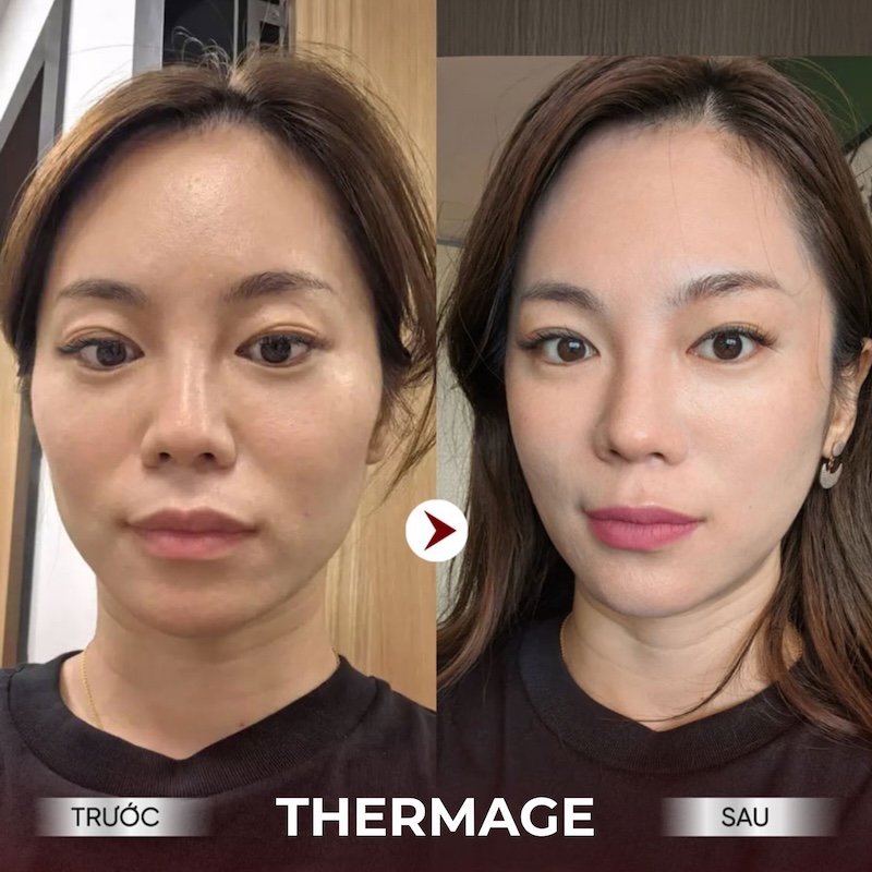 nâng cơ thermage