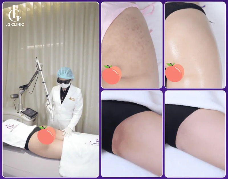 spa trị thâm quận 5