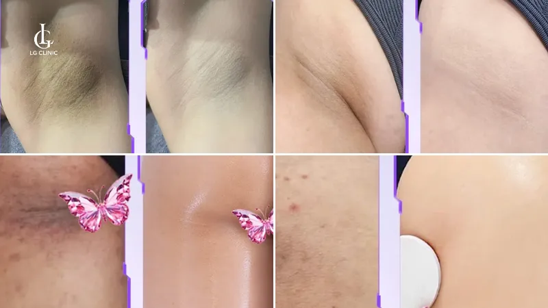 Spa trị thâm bình chánh