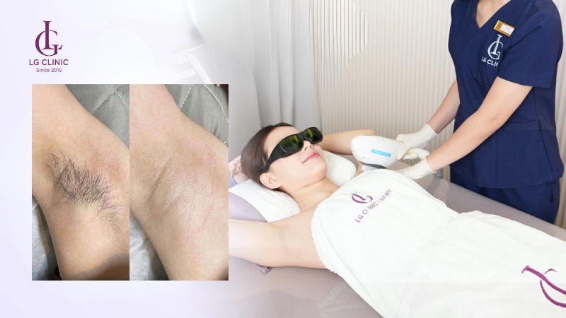 triệt lông nách có tác dụng gì