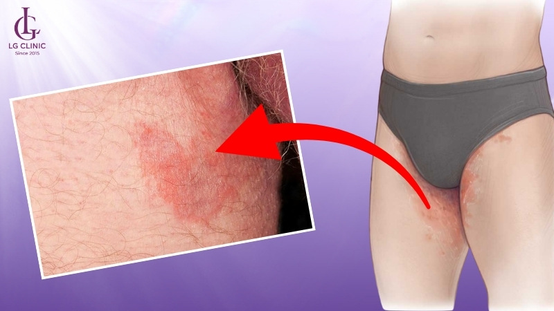 nấm vùng kín gây ngứa và nổi hạt