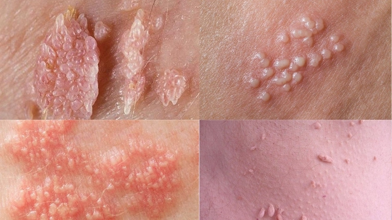 bệnh lây truyền qua đường tình dục