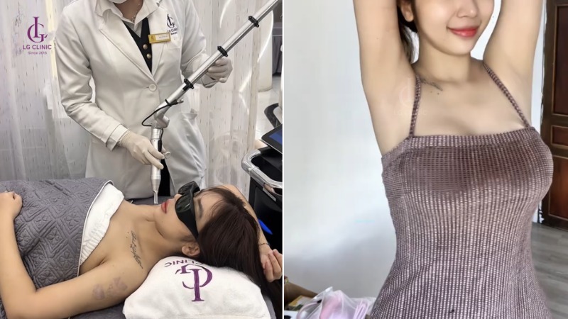 bắn laser bao lâu thì bắn lại