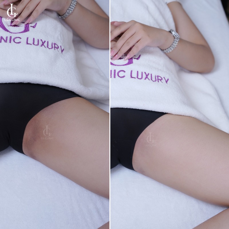 bắn laser trị thâm