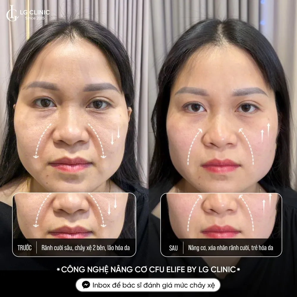 Hình ảnh khách hàng nâng cơ cfu