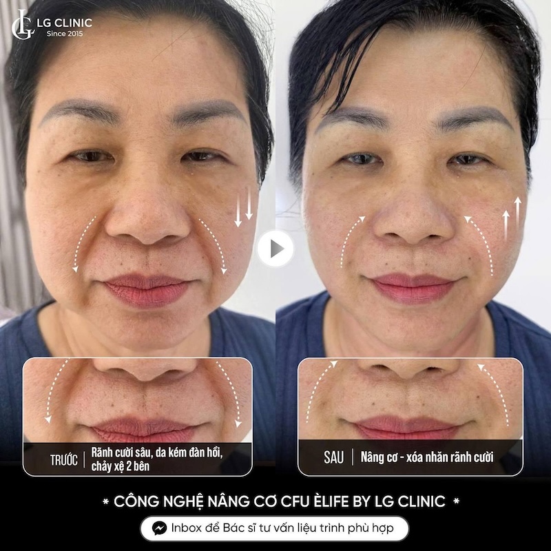 xoá nếp nhăn rãnh mũi má