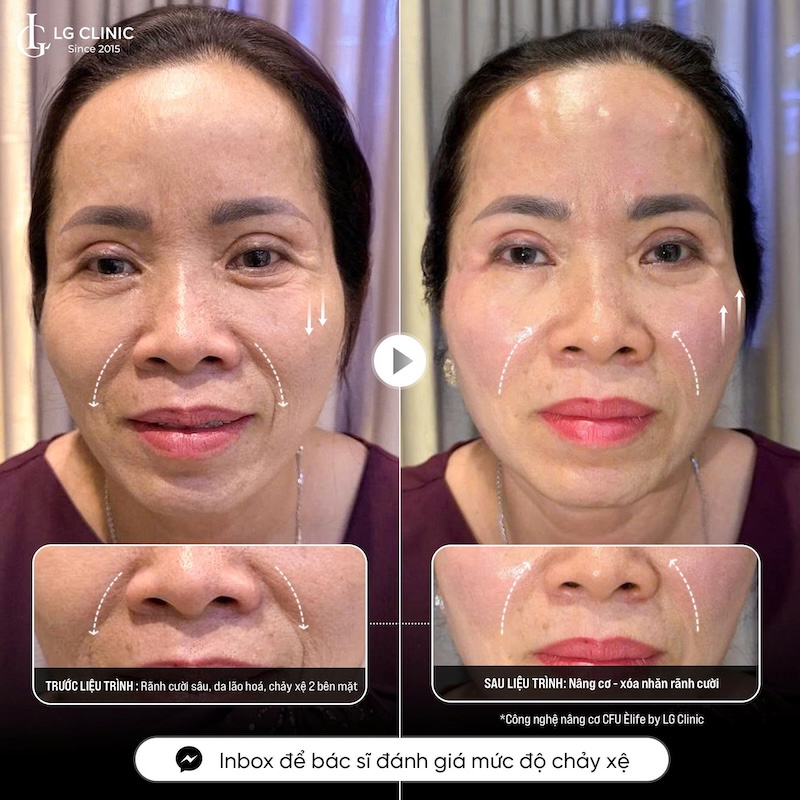 xoá nếp nhăn rãnh mũi má