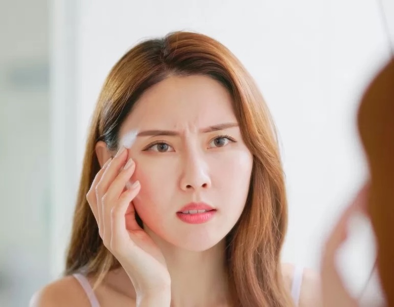 nếp nhăn ở trán