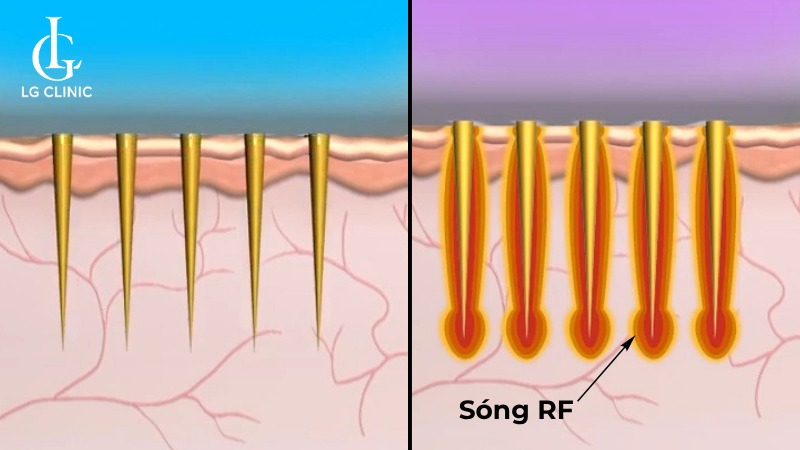 trị rạn da