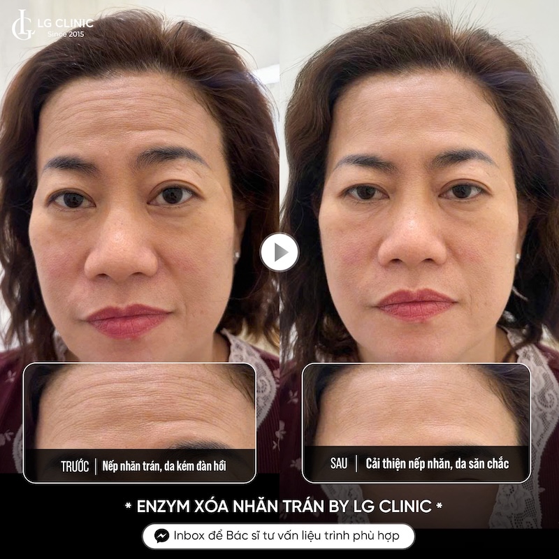 kết quả xoá nhăn trán