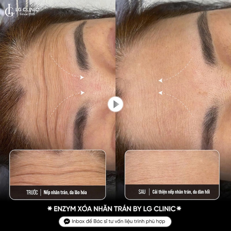 xoá nhăn trán