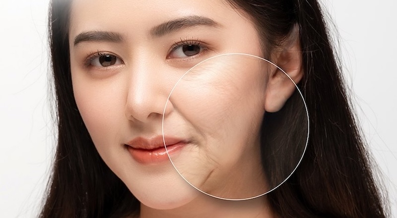 nếp nhăn rãnh cười hình thanh do nhiều nguyên nhân