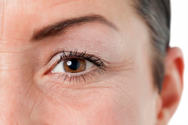 tiêm filler xoá vết chân chim