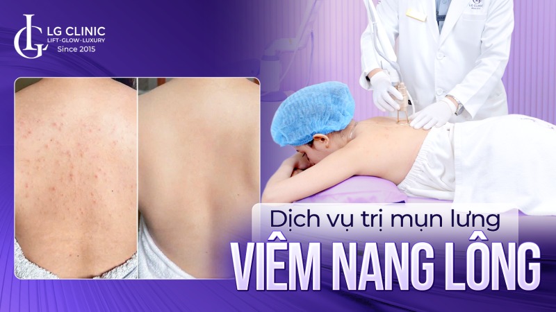 dịch vụ trị mụn lưng