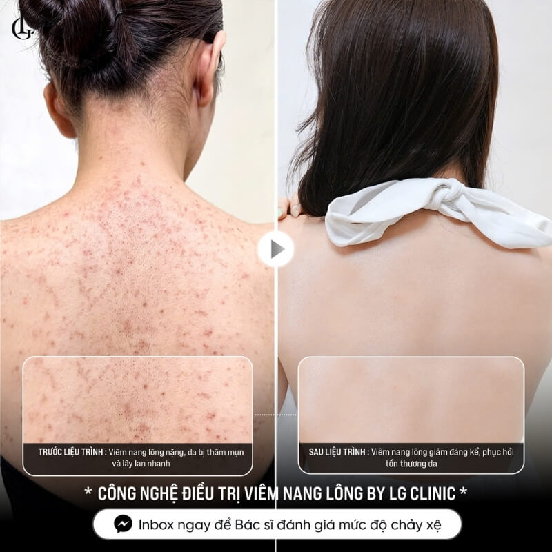 giá trị mụn lưng bao nhiêu tiền