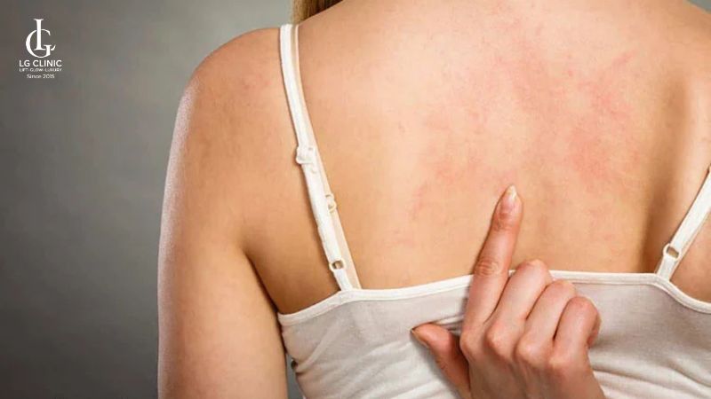 gynofar trị mụn lưng