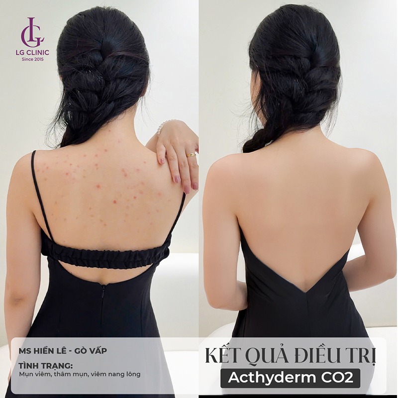 gynofar trị mụn lưng