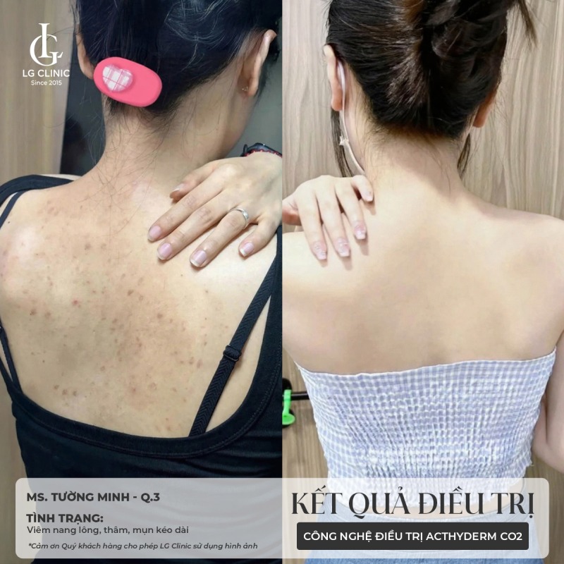 gynofar trị mụn lưng