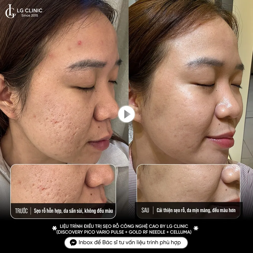 hinh ba triple treatment 01