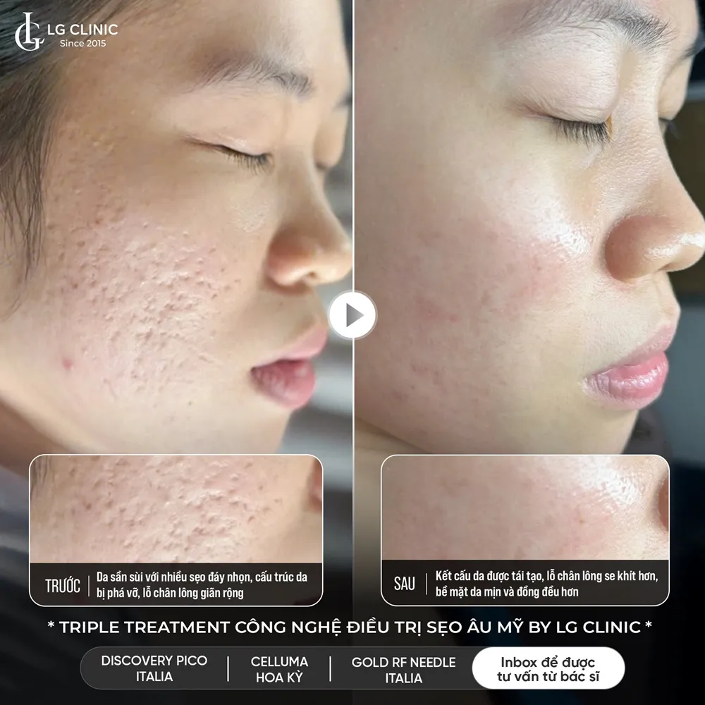 hinh ba triple treatment 02