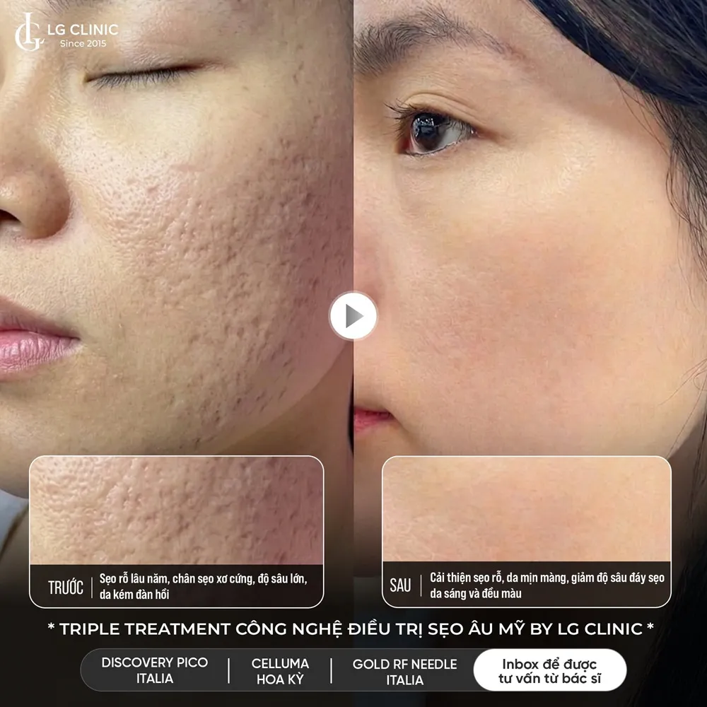 hinh ba triple treatment 03