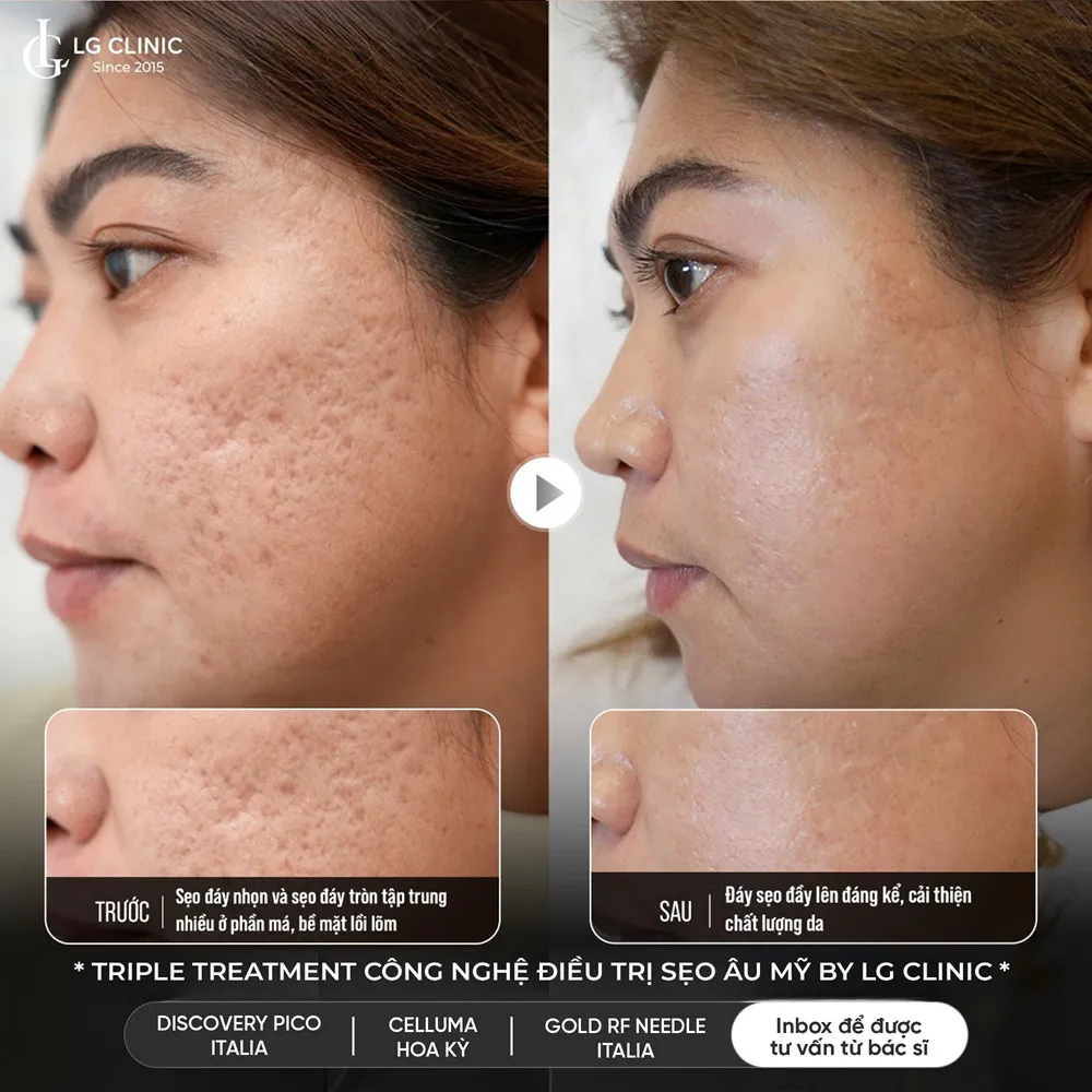 hinh ba triple treatment 04