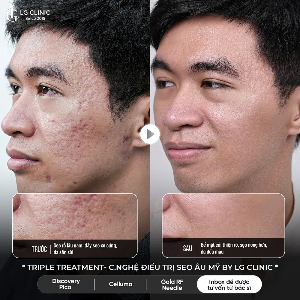 hinh ba triple treatment 05