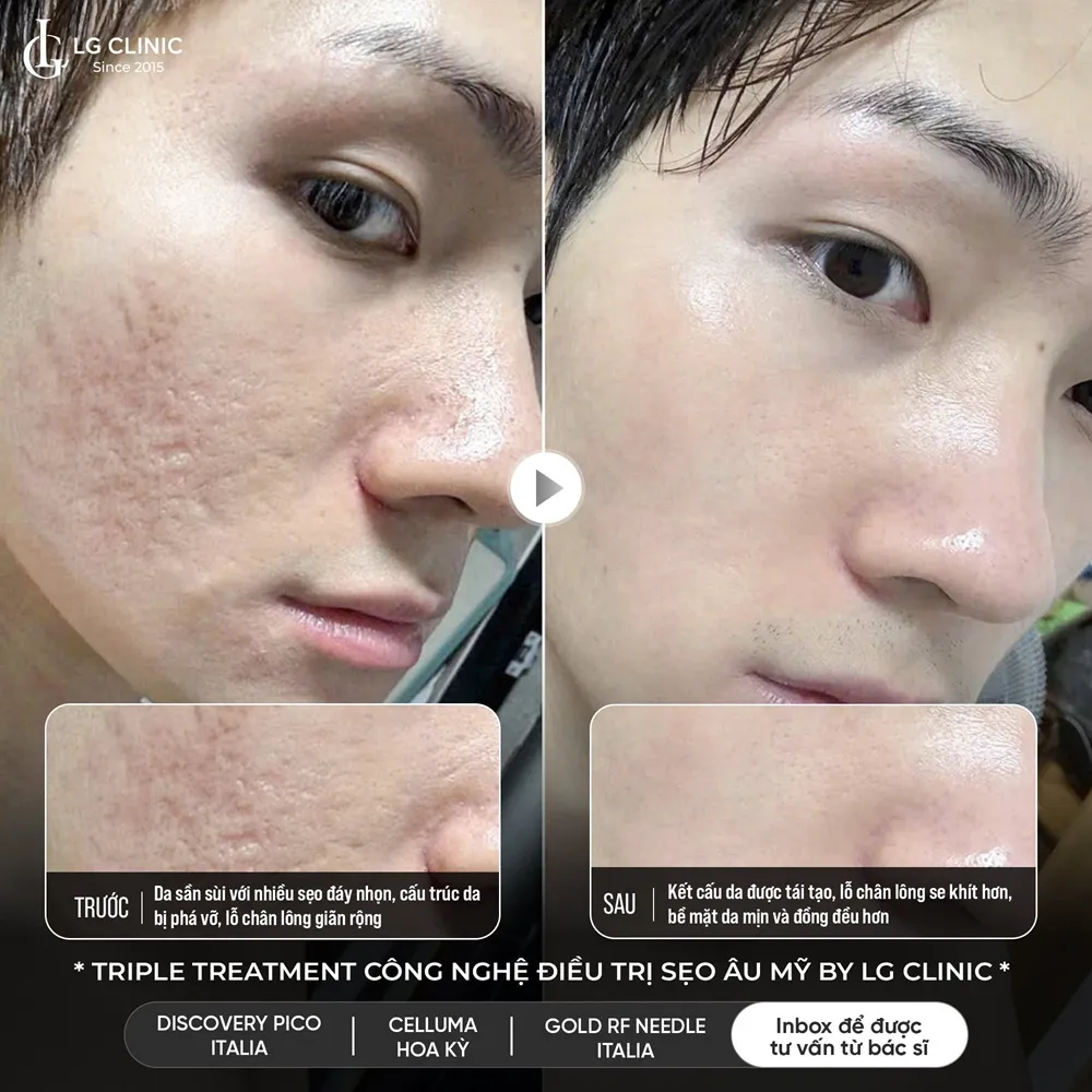 hinh ba triple treatment 06