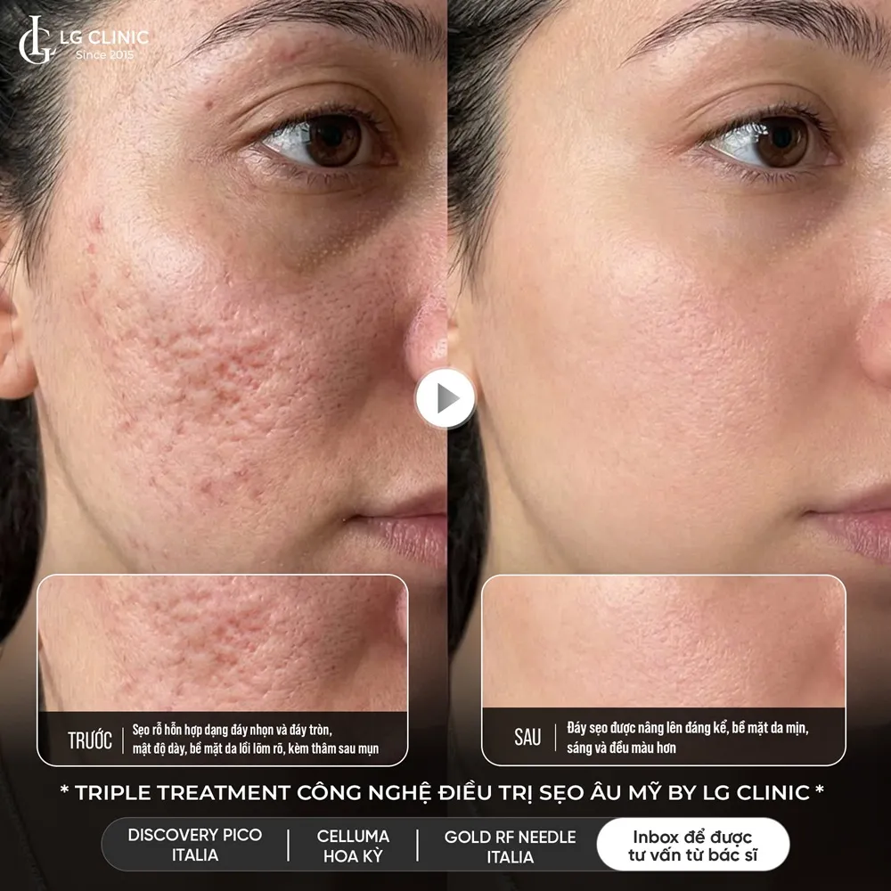 hinh ba triple treatment 07