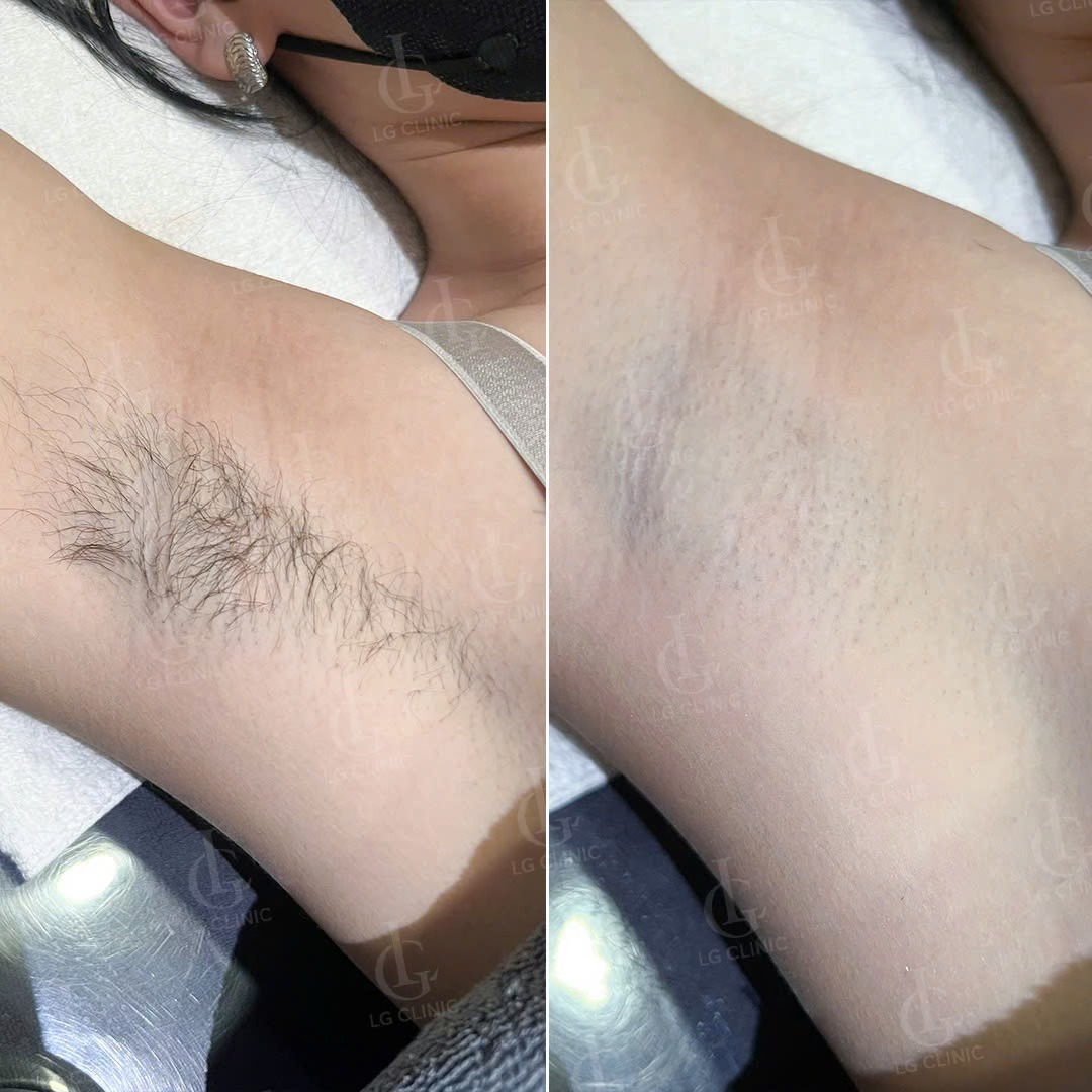 Làm sao để biết mình có bị hôi nách không