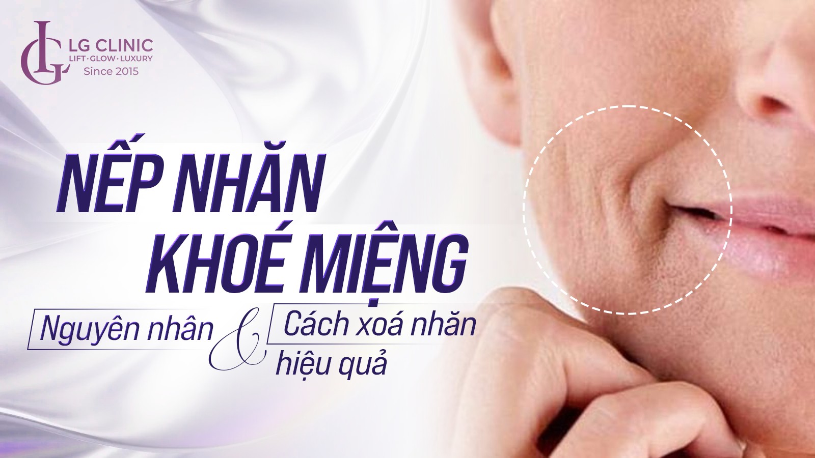 Nếp nhăn khóe miệng: Nguyên nhân và 7 cách xoá nhăn hiệu quả