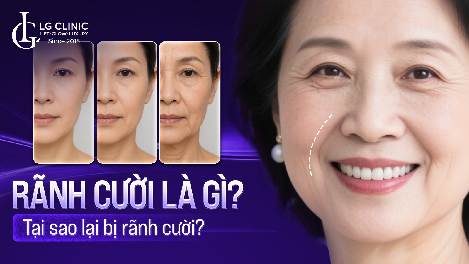 Rãnh cười là gì? Tại sao lại bị rãnh cười?