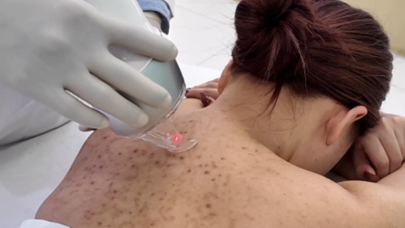 Trị mụn lưng giá bao nhiêu