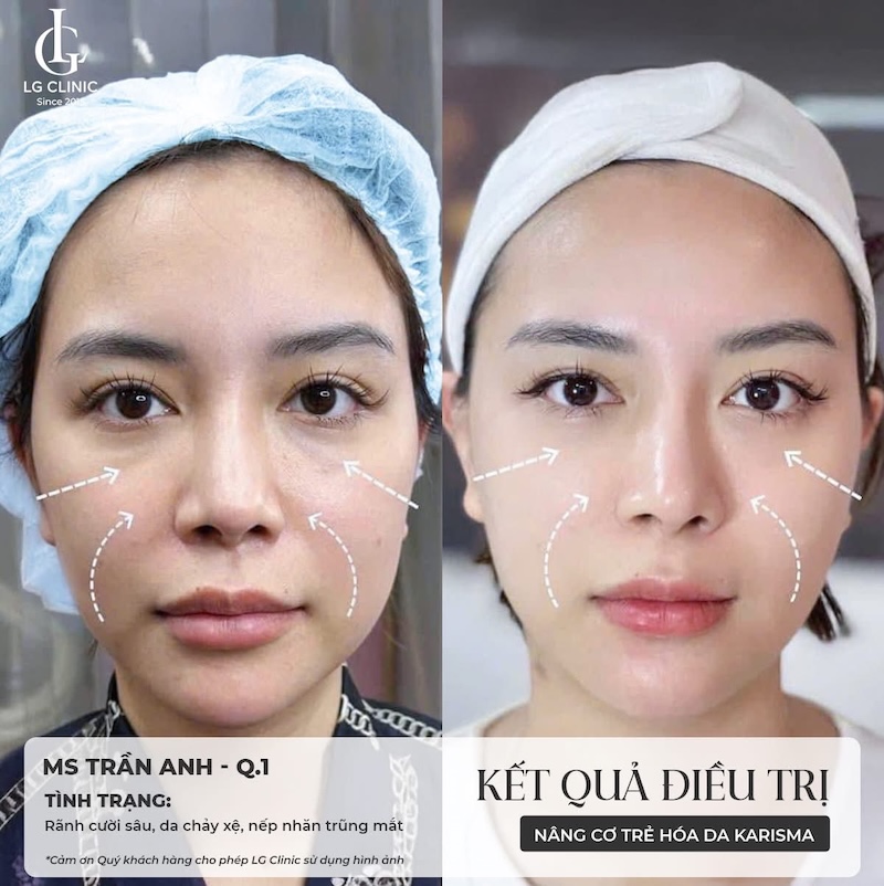 xoá nhăn tại lg clinic