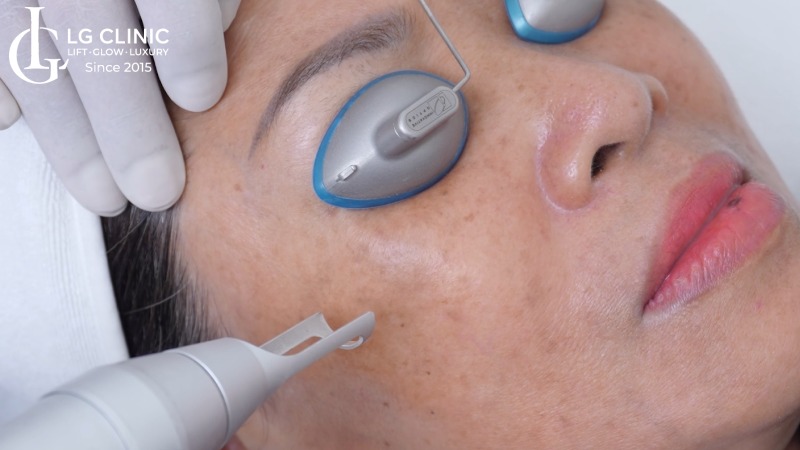 bắn tia laser trị nám