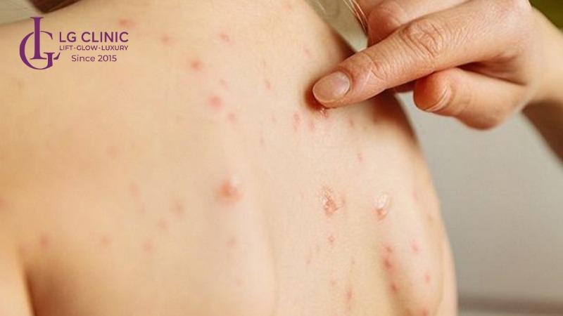 kem trị mụn lưng